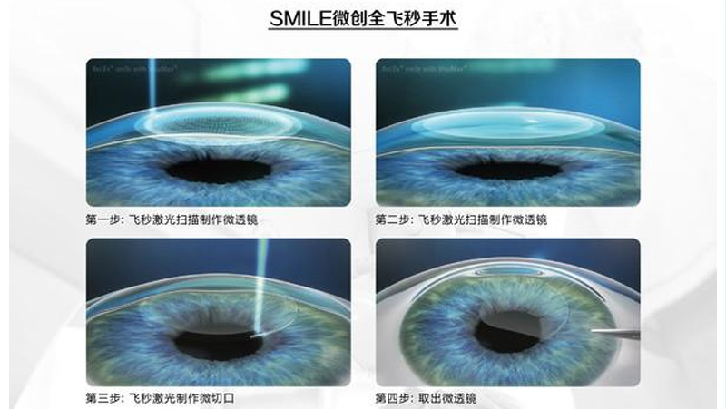 北京视力矫正手术哪家医院比较好？视力矫正手术费用大概多少？