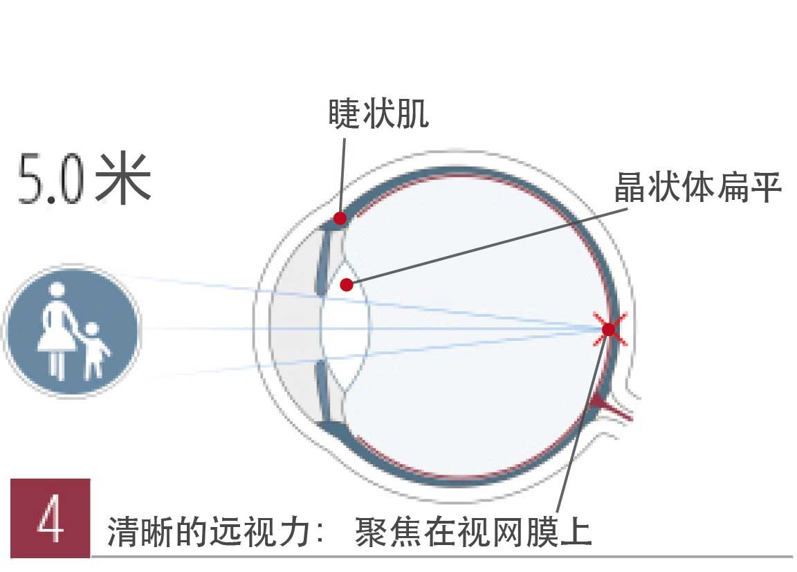 當晶狀體不能完成自身調節,入射光線就不能很好地聚焦在視網膜上,而是