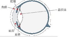 人工晶体在眼中有强烈的异物感吗?