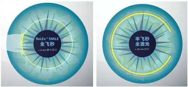 近视眼手术半飞秒和全飞秒哪个好
