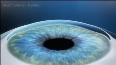 近视眼激光手术稳妥吗？