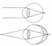 近视眼还能矫正吗