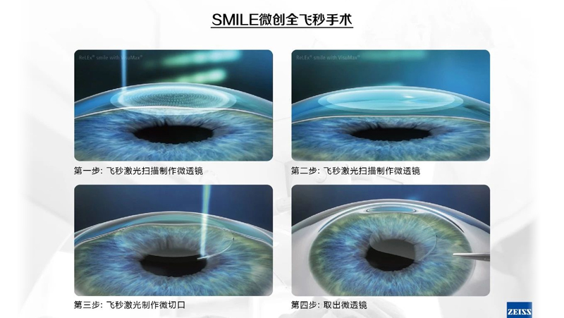 德视佳全飞秒SMILE激光手术实现无镜生活的梦想