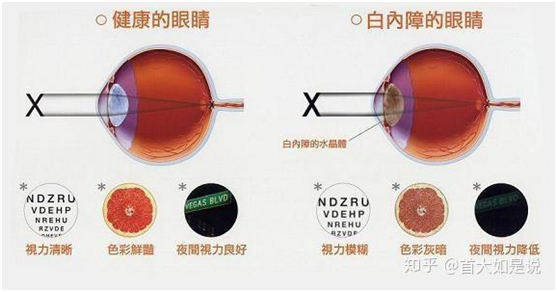 白内障,你真的了解吗?