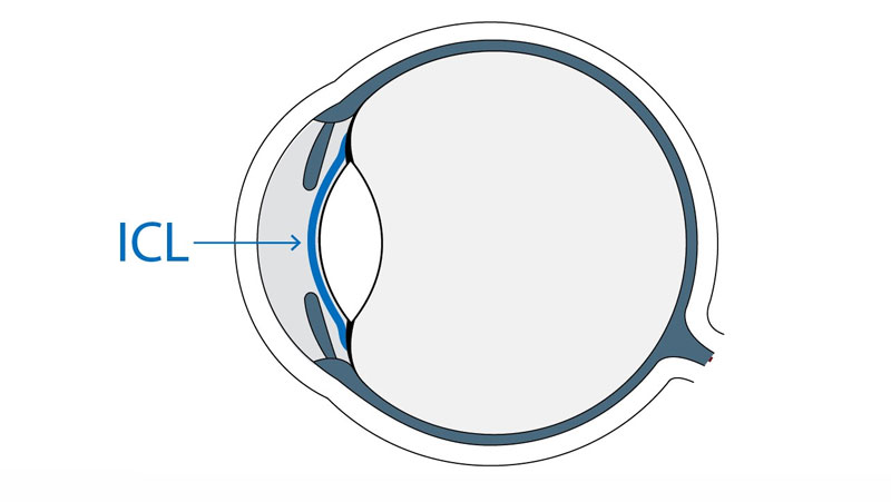 ICL晶体近视手术效果怎么样？晶体屈光手术疼吗？