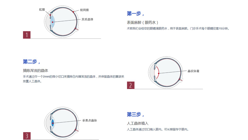 得了白内障？别怕，趁早手术效果好