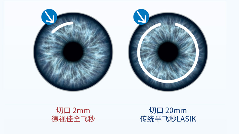 杭州全飞秒激光矫正视力多少钱？