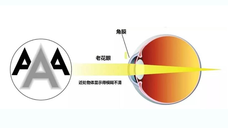 中年老花不用慌，三焦点晶体手术来帮忙