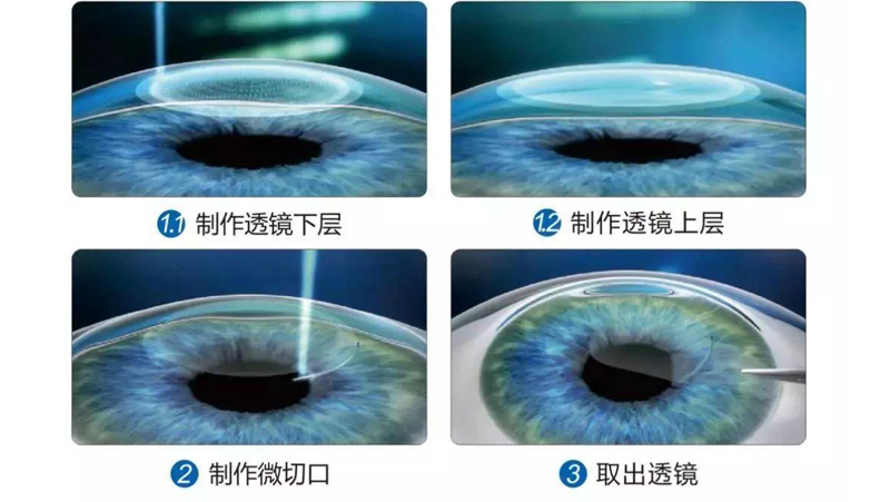 全飞秒手术如何避免术后并发症