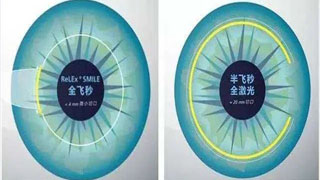 全飞秒激光和半飞秒激光的区别 半飞秒激光手术优缺点