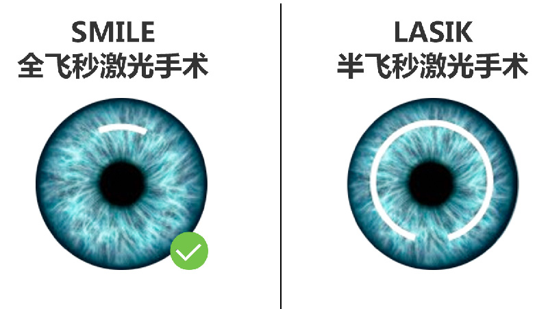 近视眼激光手术全飞秒和半飞秒价格比较