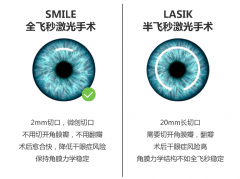 做近视矫正上海哪家医院好？近视眼激光手术全飞秒好不好？
