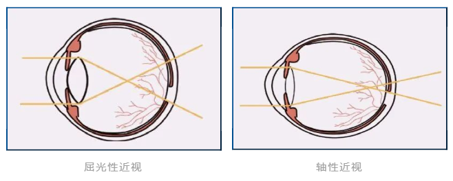 轴性近视和屈光性近视,两者之间有什么区别？