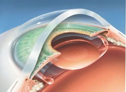 多焦点人工晶状体手术老花眼的原理