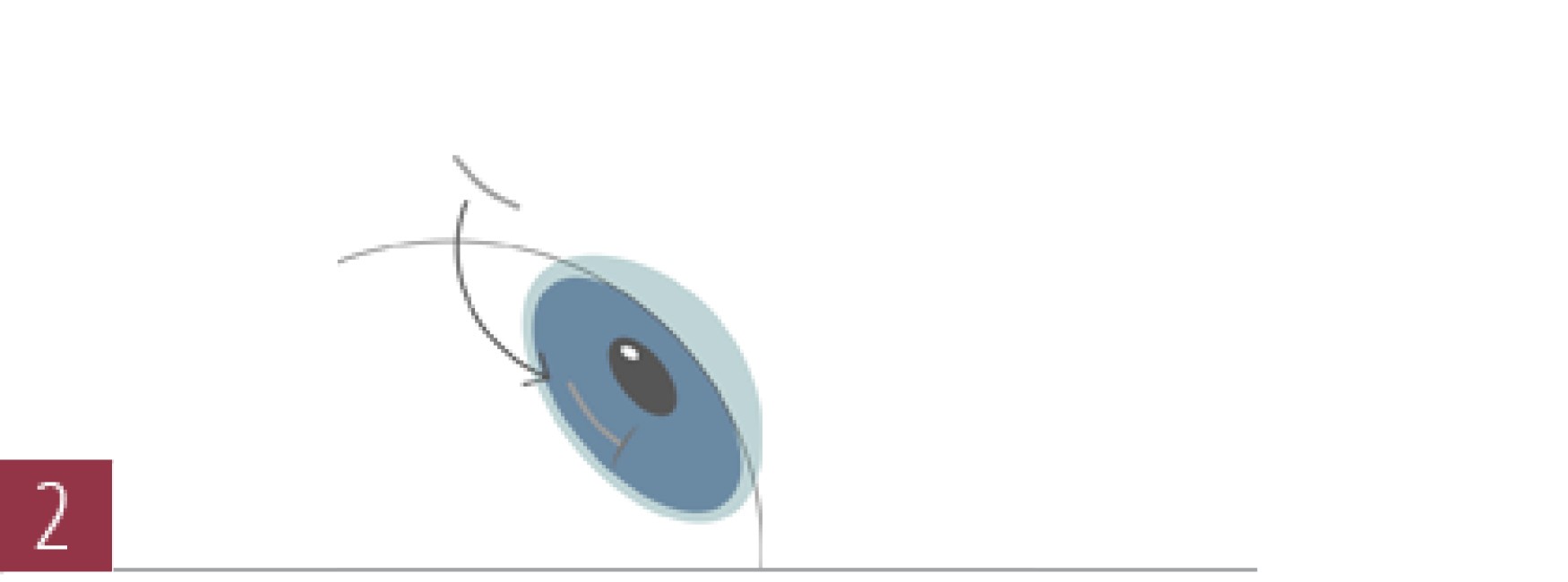 圆锥角膜手术
