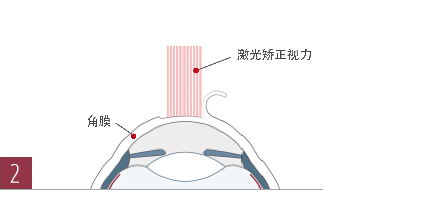 北京德视佳介绍飞秒激光LASIK手术过程