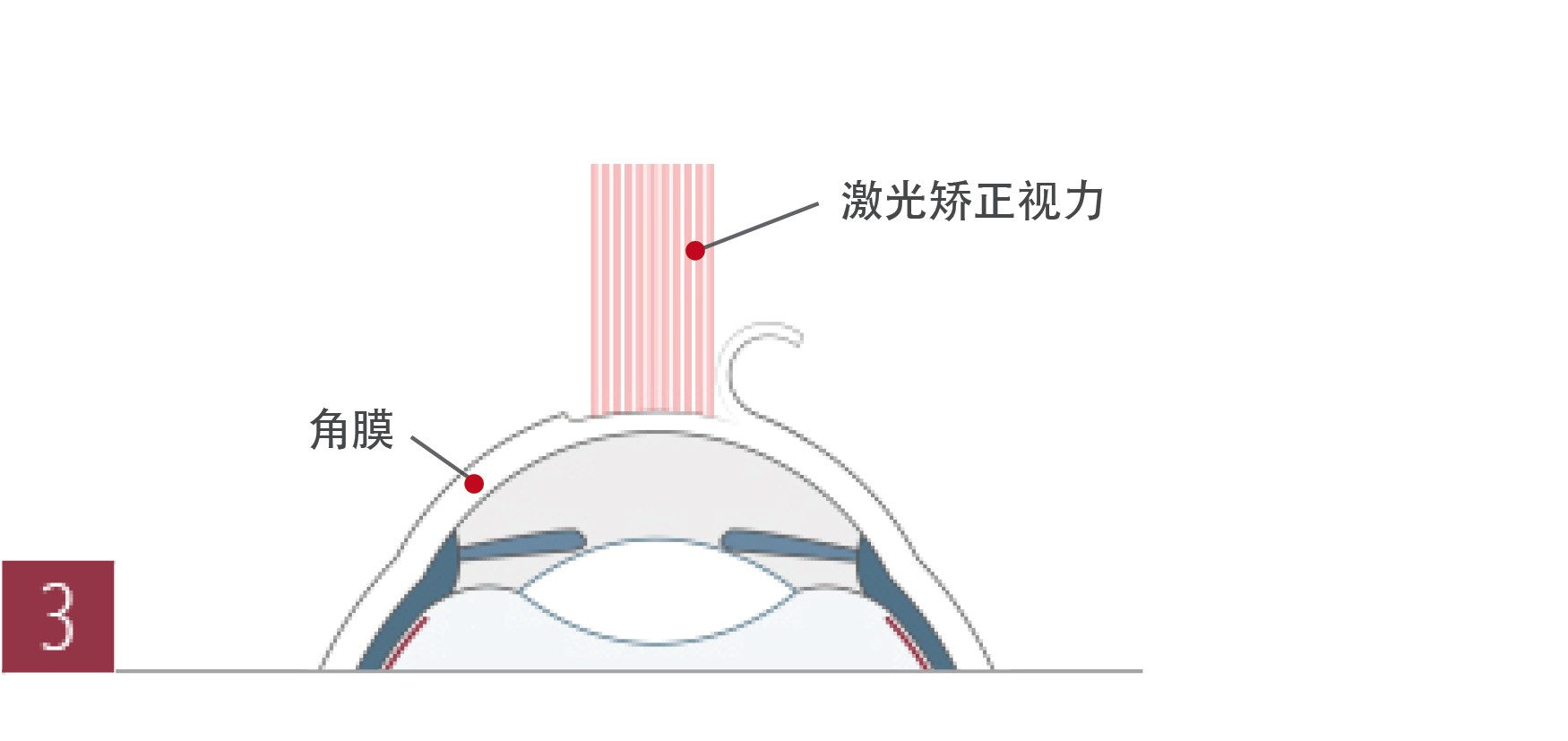 广州ee准分子激光（eeLASIK）手术过程