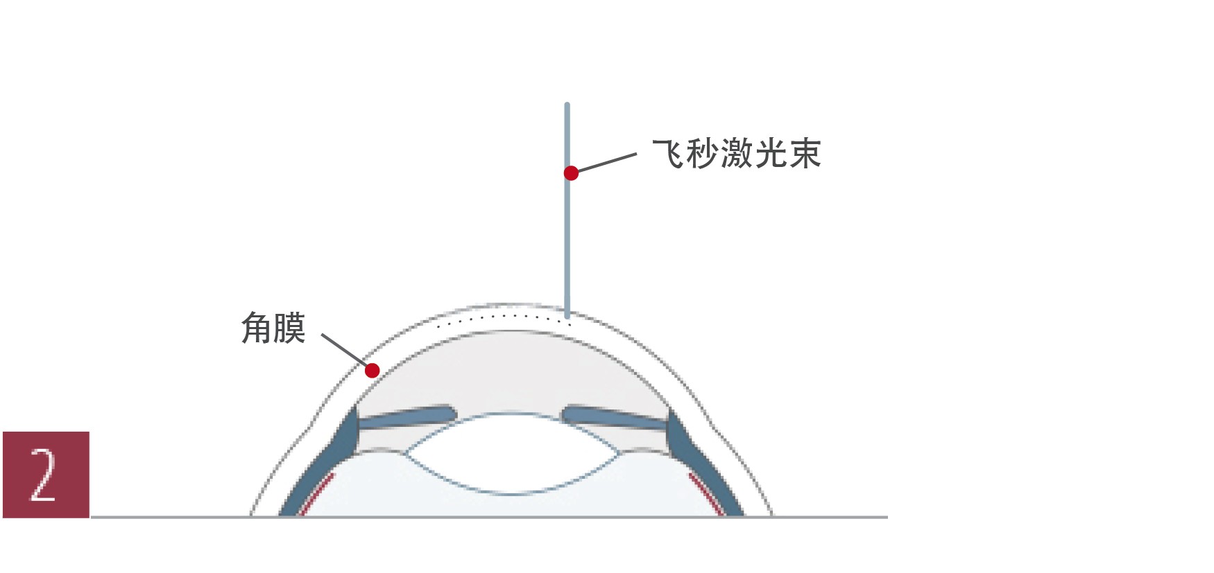 上海ee准分子激光手术过程