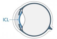深圳ICL手术的介绍