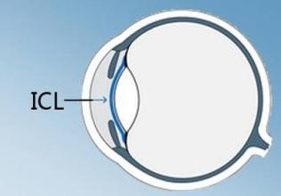 上海ICL晶体植入手术的介绍