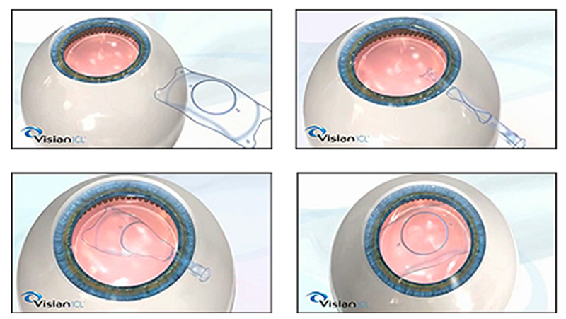 为什么高度近视患者可以选择ICL晶体植入术