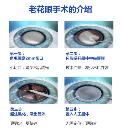 杭州老花眼矫正，三焦人工晶体手术多少钱？