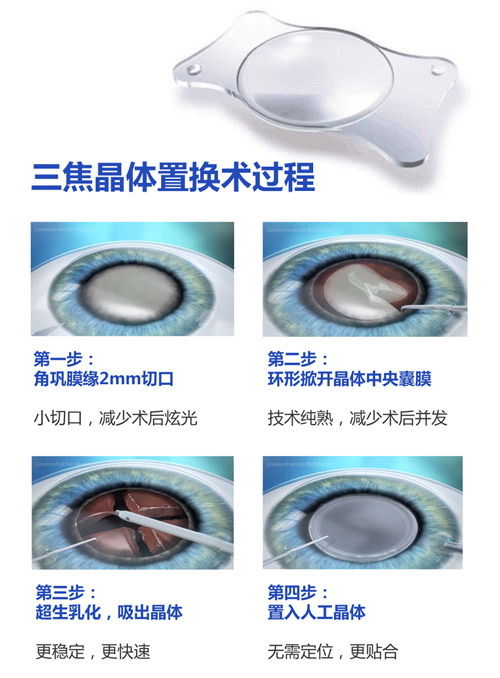杭州私立眼科哪家做白内障手术好？微创白内障手术费用多少？